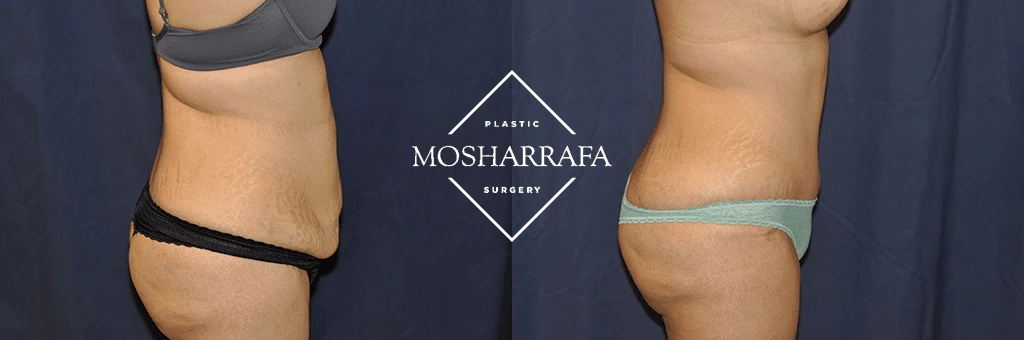 Tummy tuck before and after: side view showing flattened abdomen and restored waistline definition