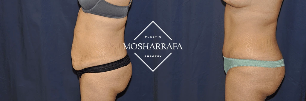 Tummy tuck before and after: side profile view demonstrating smoother abdominal surface and enhanced body contour
