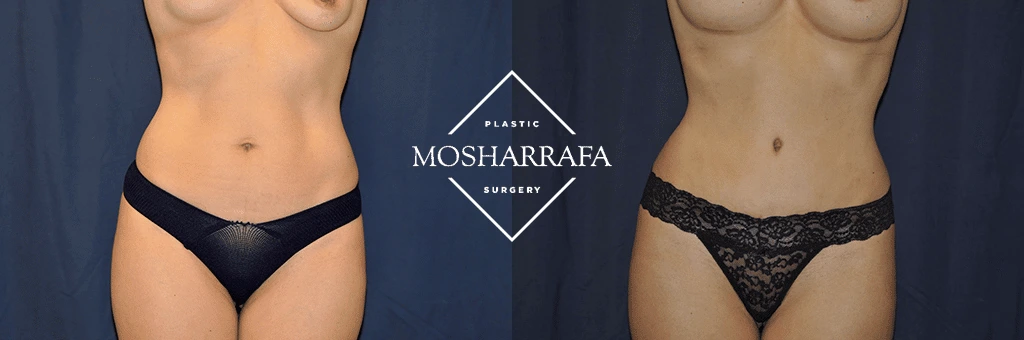 Before and after tummy tuck front view, showing reduced abdominal skin and improved contour