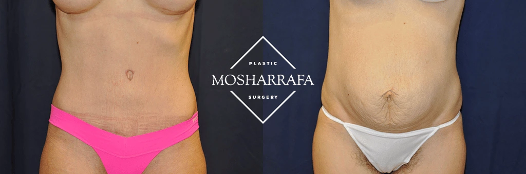Before and after tummy tuck front view showing flattened abdomen and improved contour