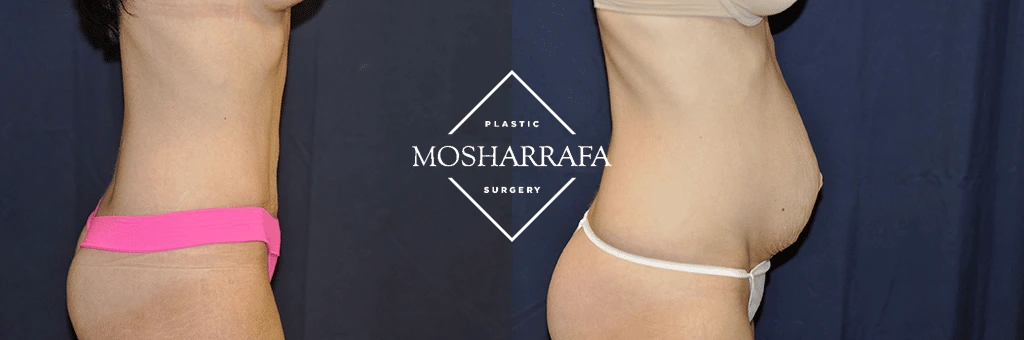 Before and after tummy tuck side view showing reduced abdominal projection