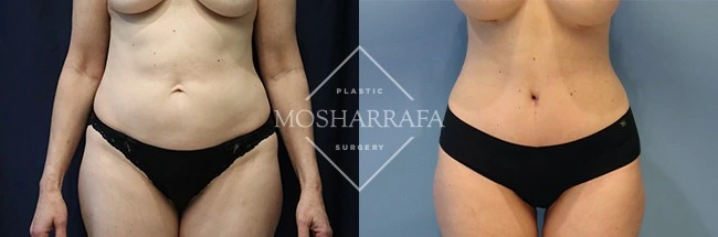 tummy-tuck-case-309-1