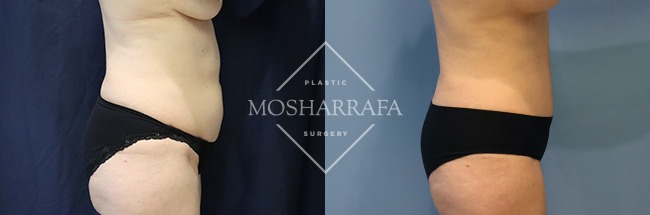 tummy-tuck-case-309-2