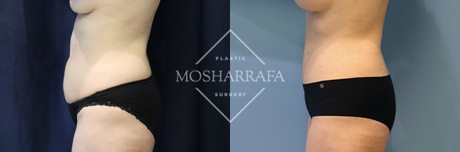 tummy-tuck-case-309-3
