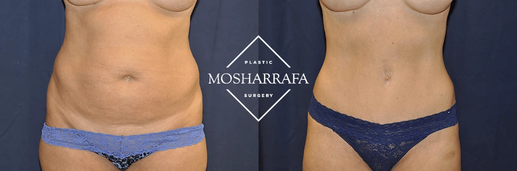 Before and after tummy tuck: front view showing reduced abdominal fullness and improved contour