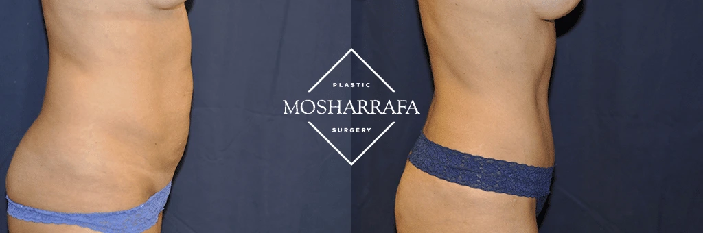 Before and after tummy tuck: side view showing flattened abdomen and refined midsection