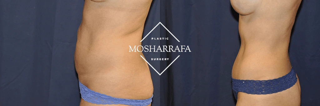 Before and after tummy tuck: oblique side view demonstrating tightened abdominal profile