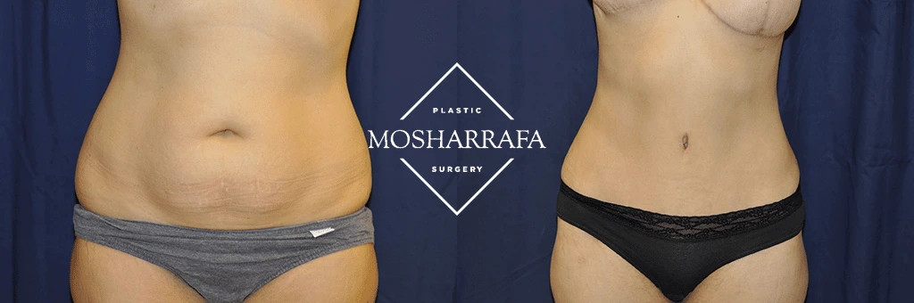 Before and after tummy tuck front view showing flattened abdomen and improved waistline definition
