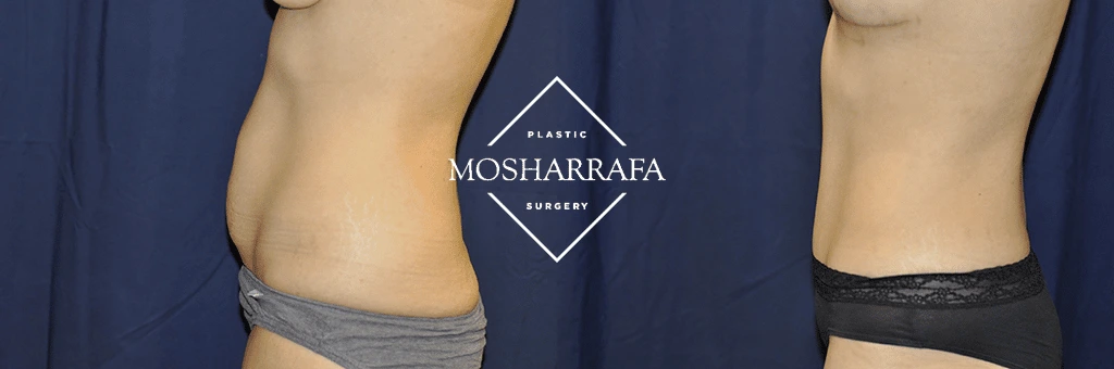 Before and after tummy tuck side view showing enhanced abdominal flatness and torso definition