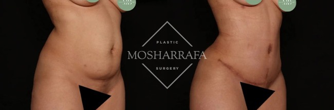 Before and after tummy tuck showing front view comparison