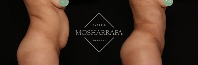 Before and after tummy tuck showing side profile comparison