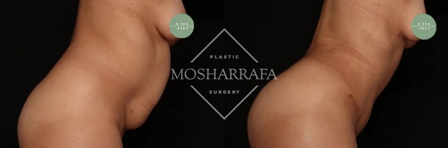 Before and after tummy tuck showing oblique angle comparison