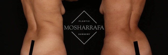 Before and after tummy tuck showing front lower abdomen comparison