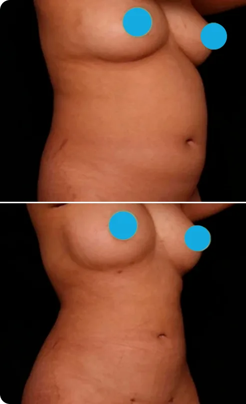 Liposuction Before and After A Banner