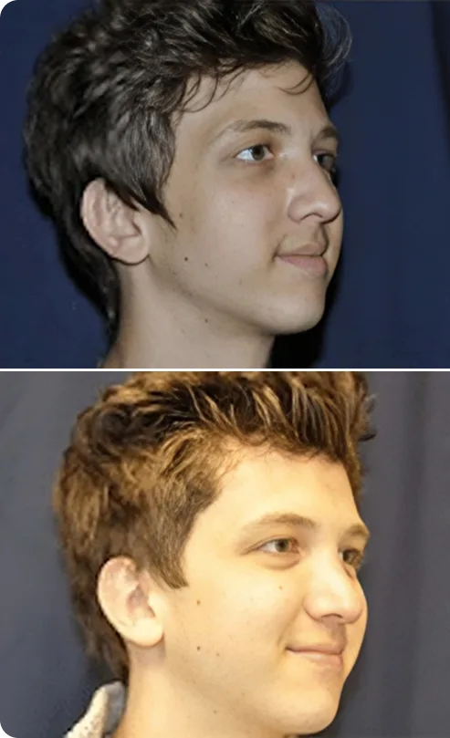 Rhinoplasty Before and After A Banner