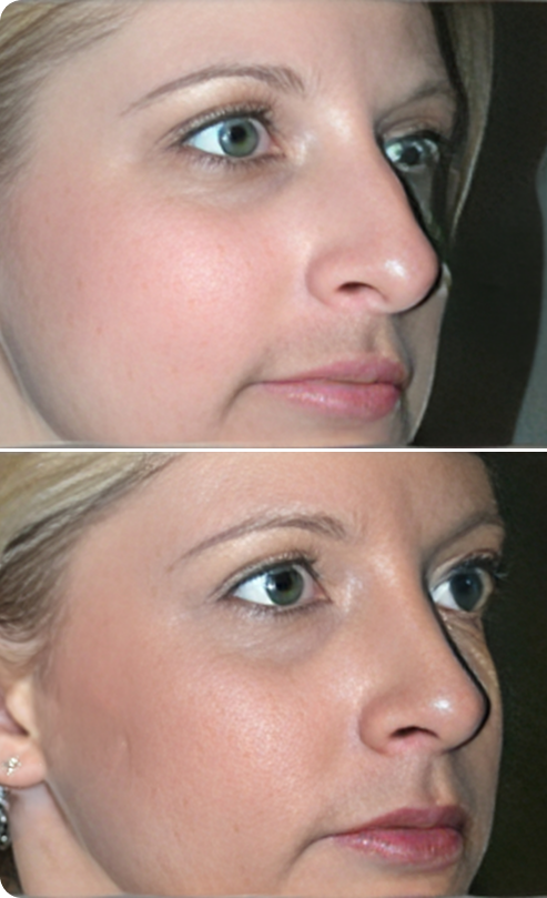 Rhinoplasty Before and After B Banner