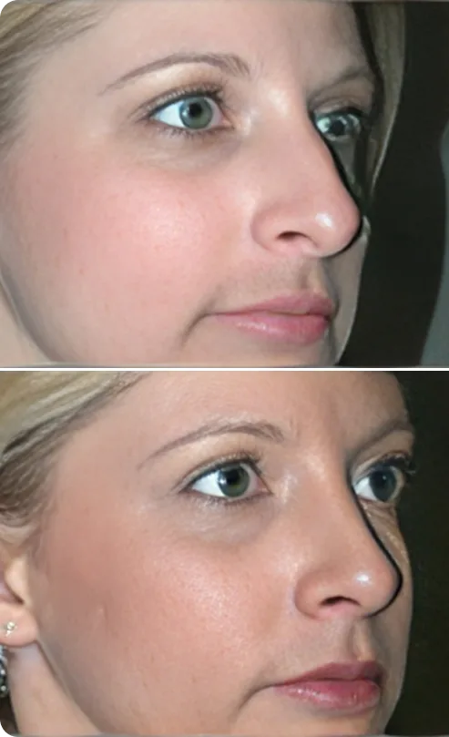 Rhinoplasty Before and After B Banner