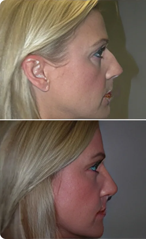 Rhinoplasty Before and After C Banner