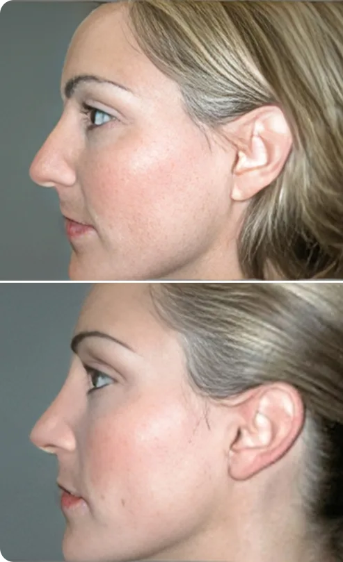 Rhinoplasty Before and After D Banner