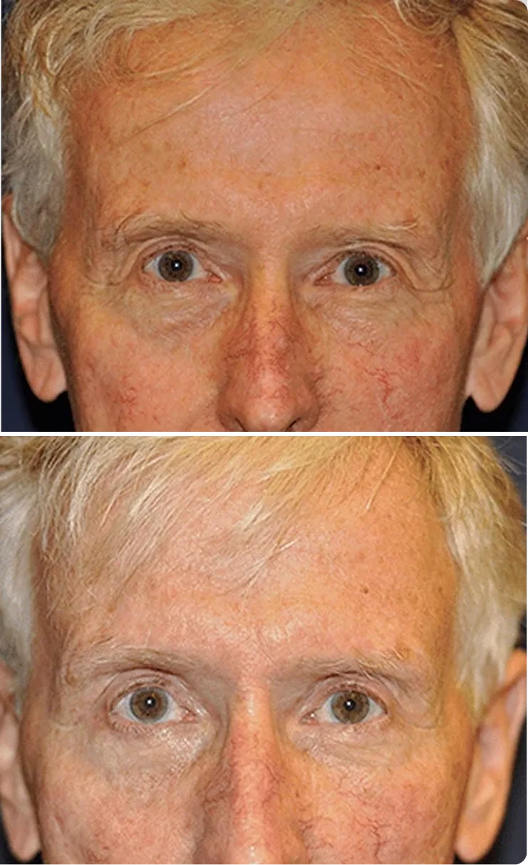 Blepharoplasty Before and After A Banner