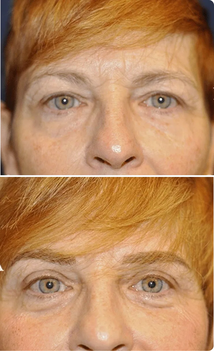 Blepharoplasty Before and After B Banner