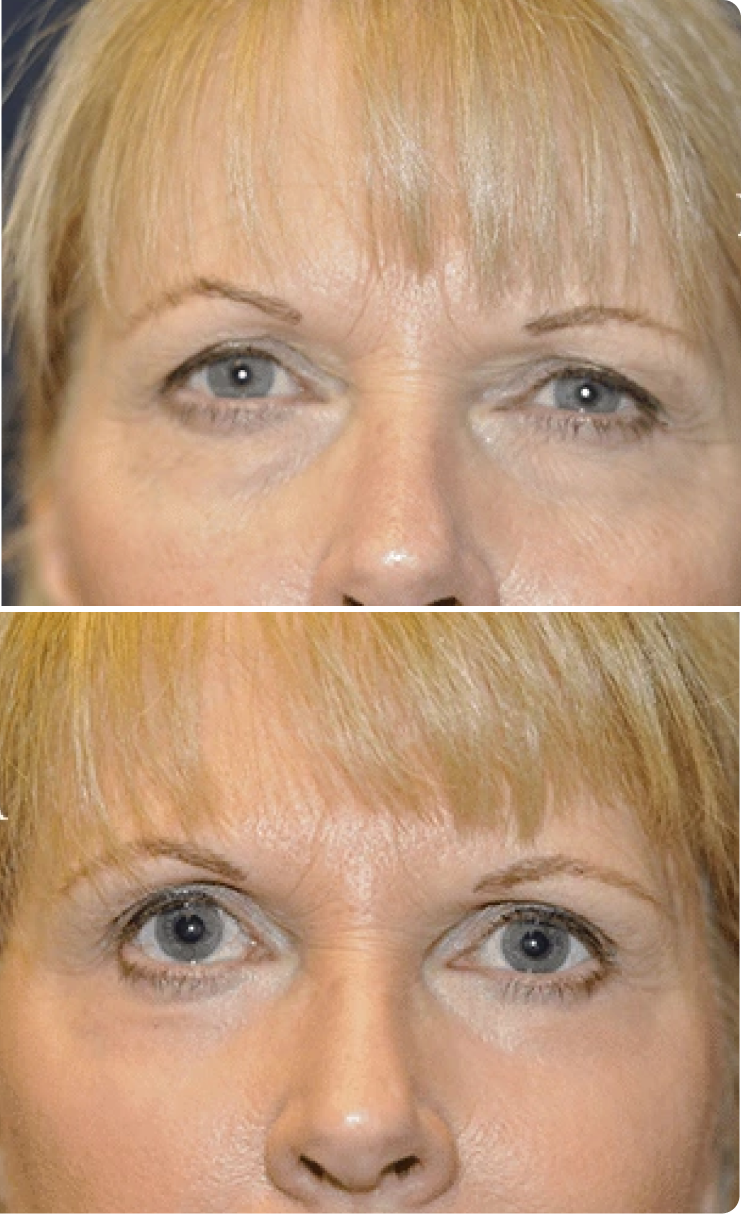 Blepharoplasty Before and After C Banner