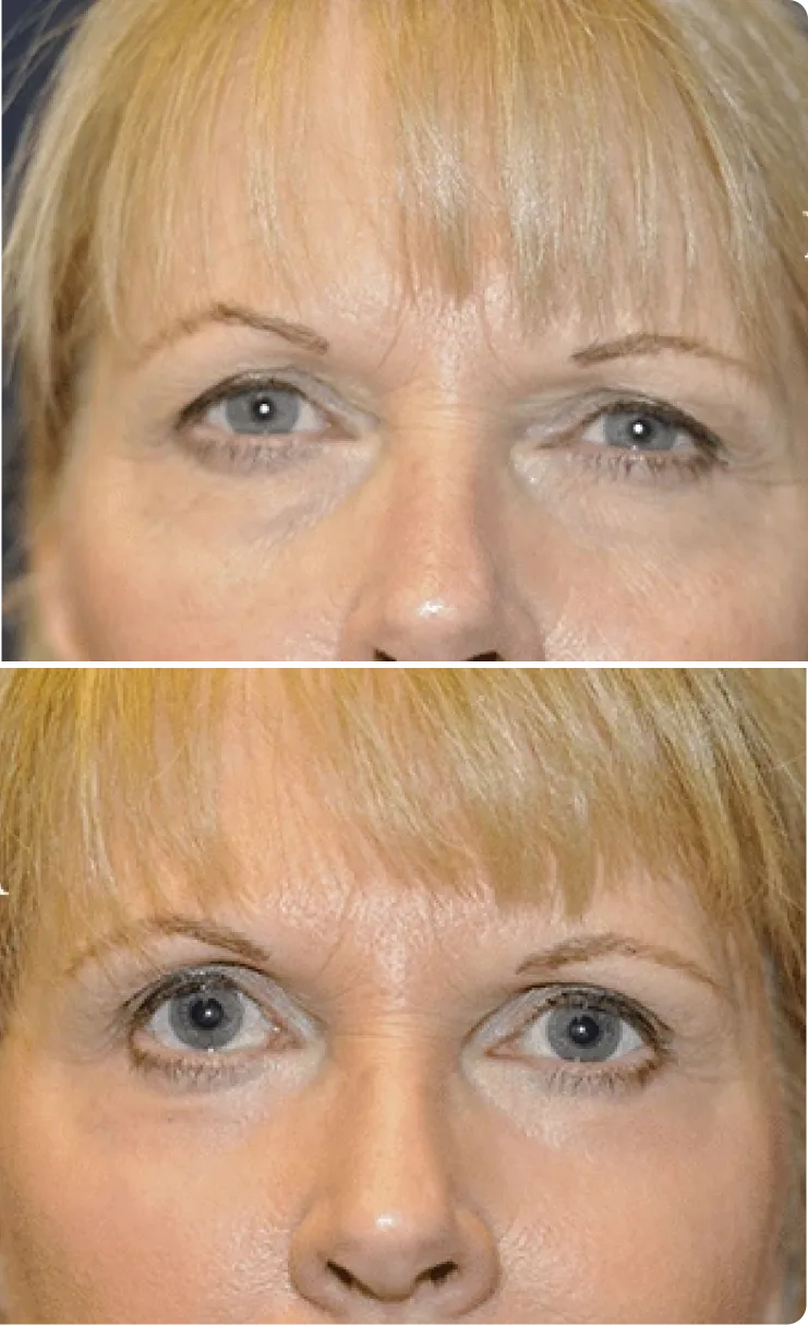 Blepharoplasty Before and After C Banner