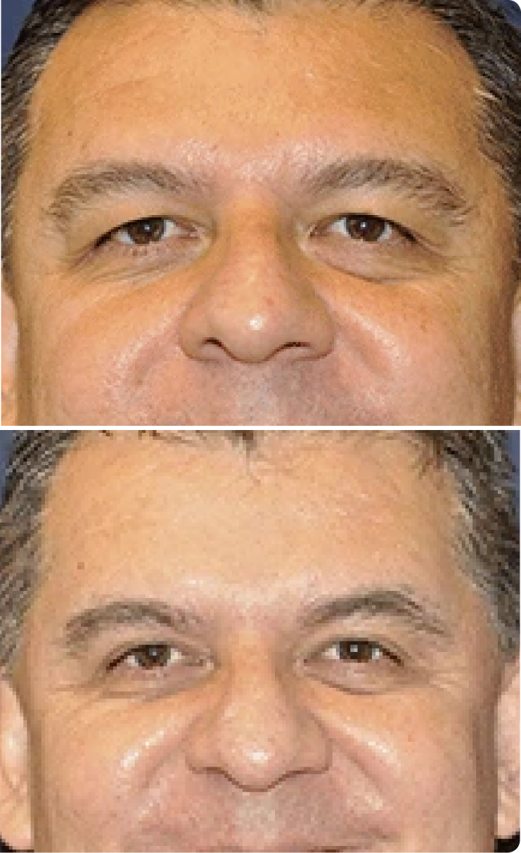 Blepharoplasty Before and After C Banner
