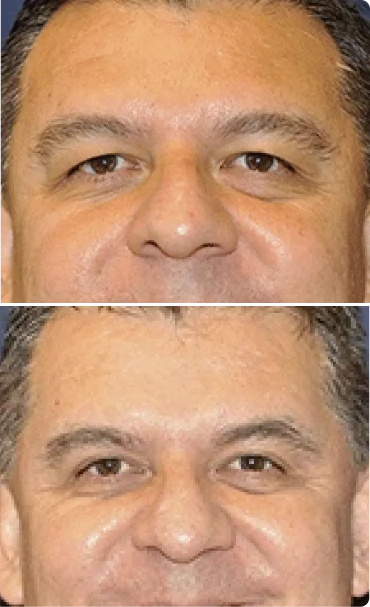 Blepharoplasty Before and After C Banner