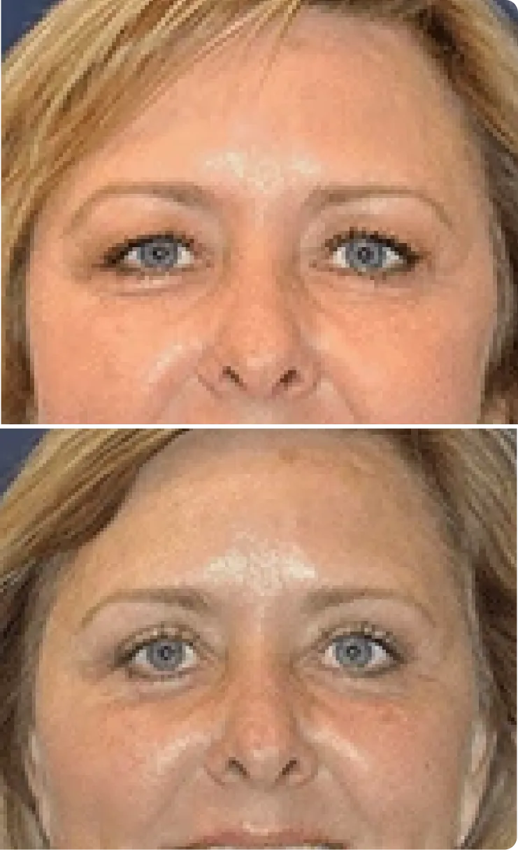 Blepharoplasty Before and After D Banner