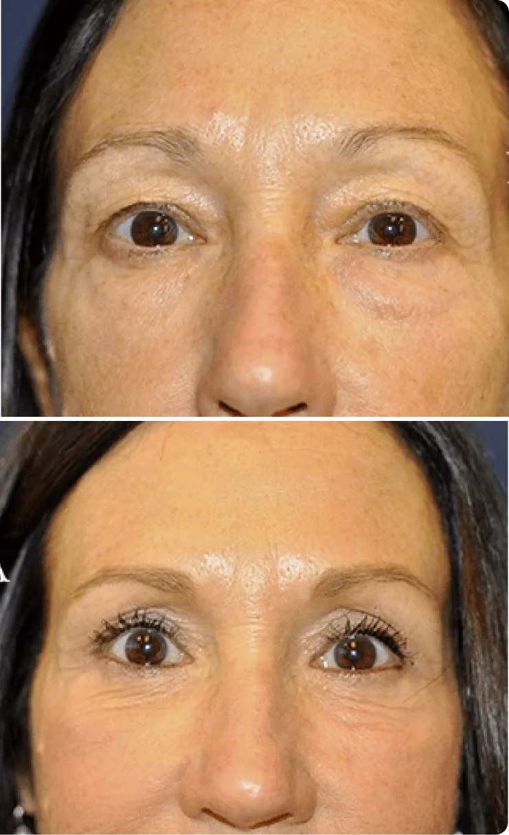 Blepharoplasty Before and After E Banner