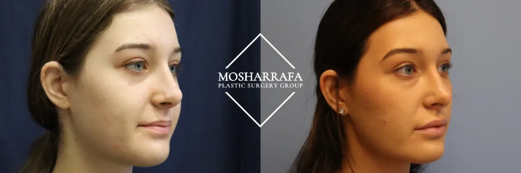 Before and after profile comparison of facial contouring results by Mosharrafa Plastic Surgery Group