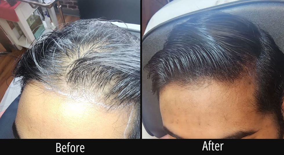 Before and after comparison showing hairline restoration with increased hair density at the crown and hairline