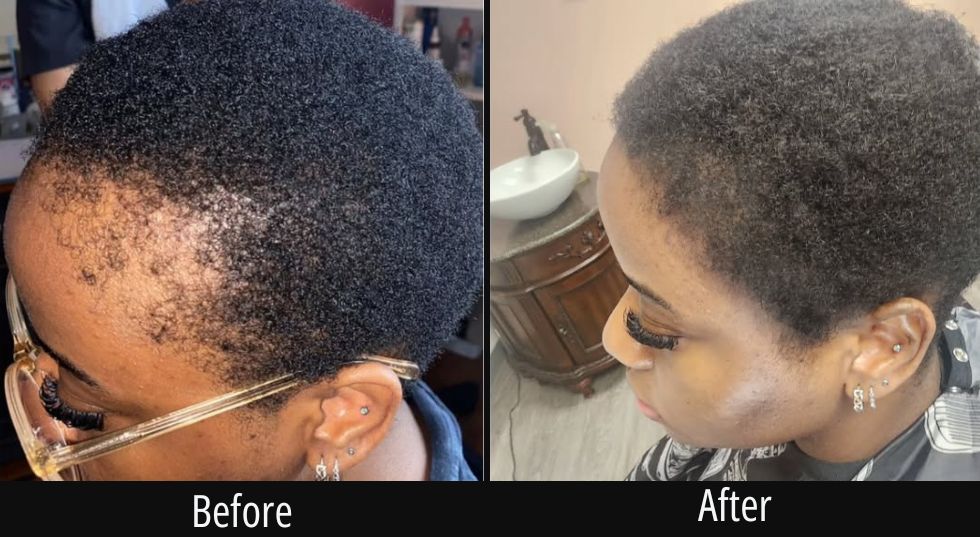 Before and after comparison showing scalp treatment results with improved hair coverage on the crown