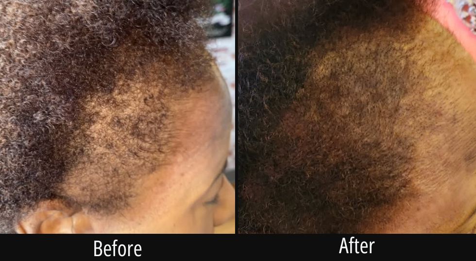 Before and after comparison of scalp treatment showing improved hair density and color