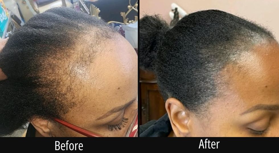 Before and after comparison of scalp micropigmentation treatment showing fuller hair appearance