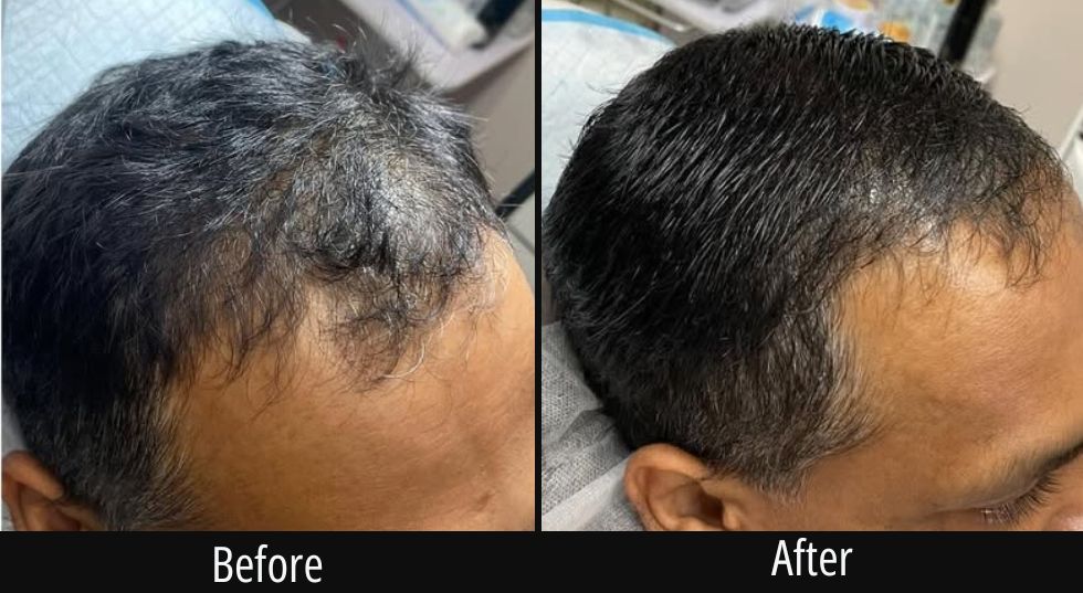 Before and after scalp treatment showing increased hair density on crown
