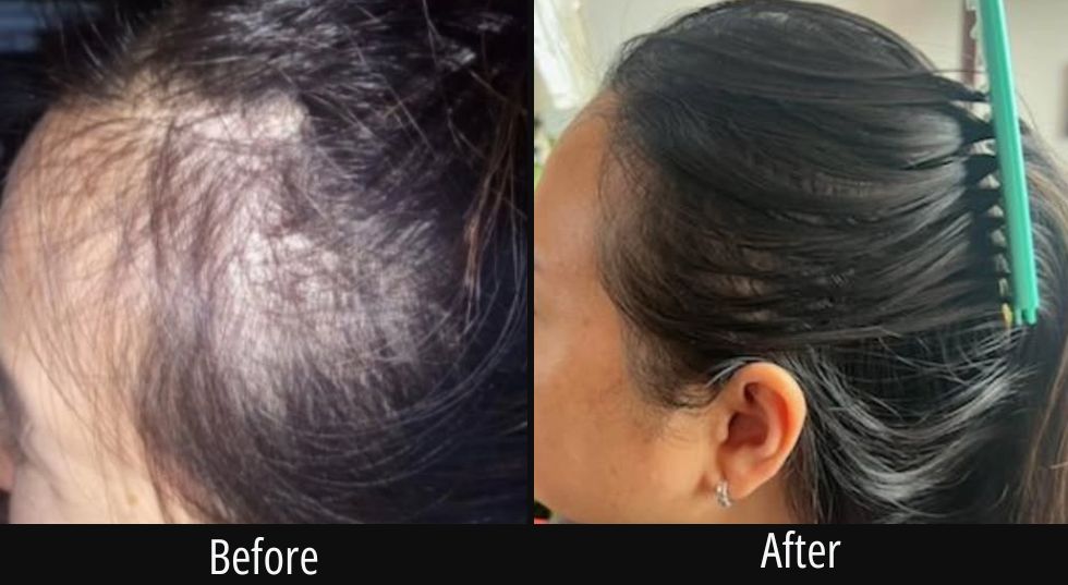 Before and after scalp treatment showing improved hair coverage on back of head