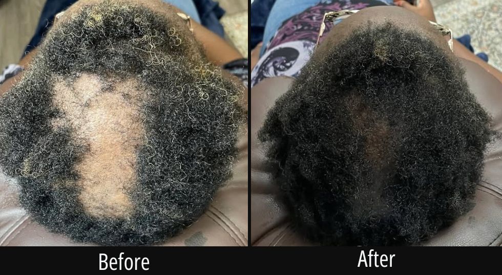 Before and after scalp treatment showing fuller hair growth on crown area