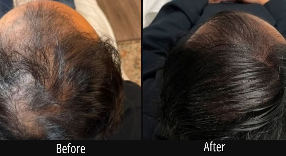 Before and after scalp treatment showing restored hair coverage on top of head