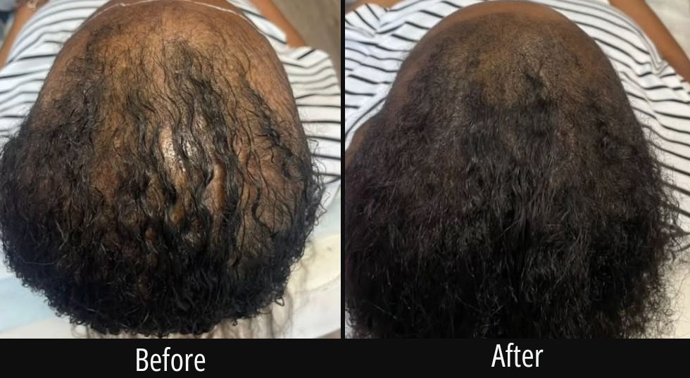 Before and after scalp treatment showing denser hair growth on back of scalp