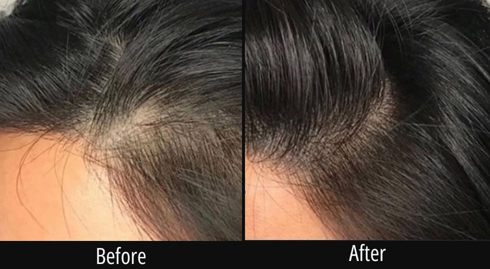 Before and after comparison of scalp hair density at the crown, showing increased hair coverage after treatment