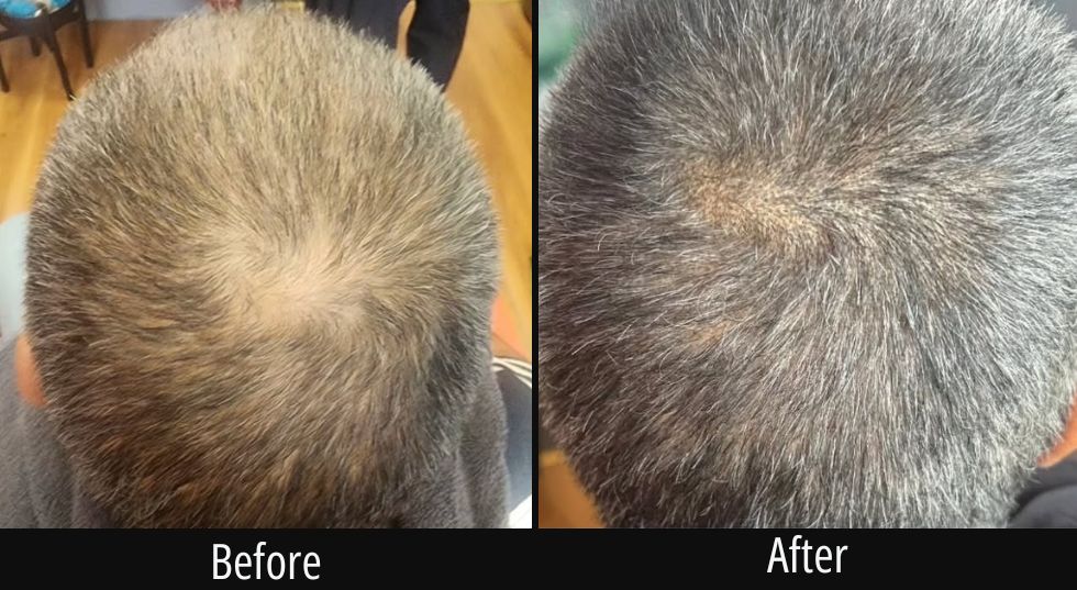 Before and after overhead view of scalp showing improved hair density and reduced visible scalp area