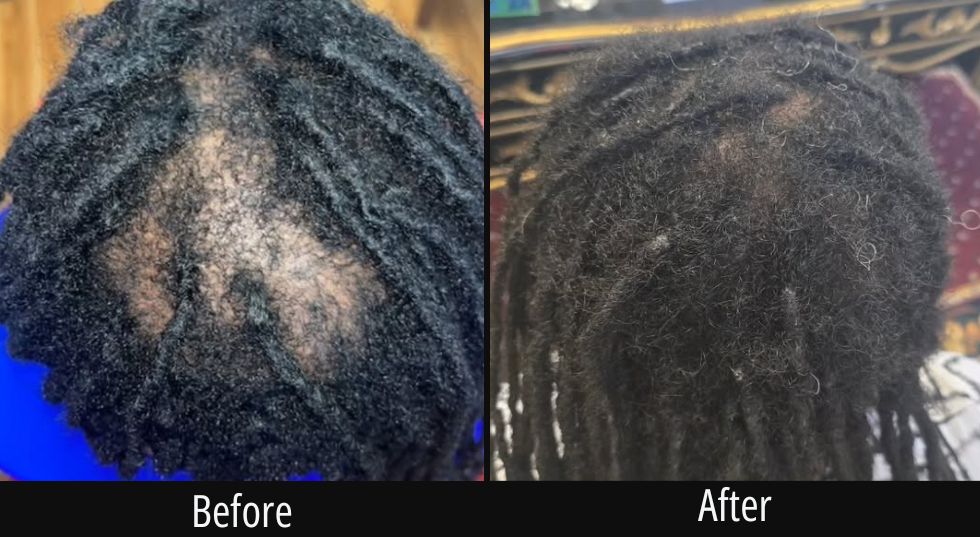 Before and after overhead view of scalp with textured hair showing fuller hair coverage after treatment