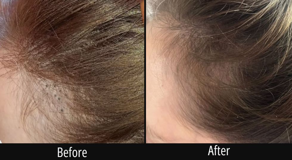 Before and after side view of scalp showing increased hair growth and reduced hair loss area