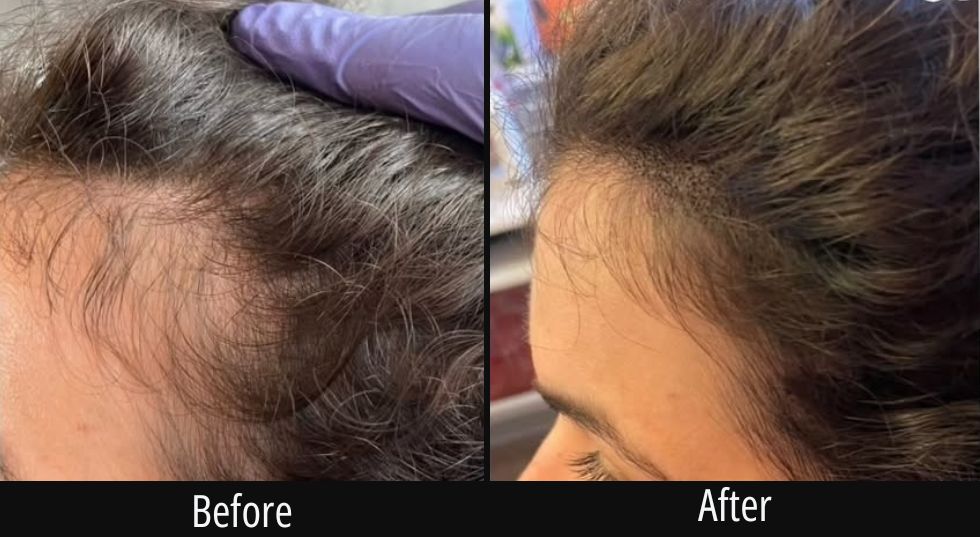 Before and after close-up of hairline and temple area showing improved hair density and coverage