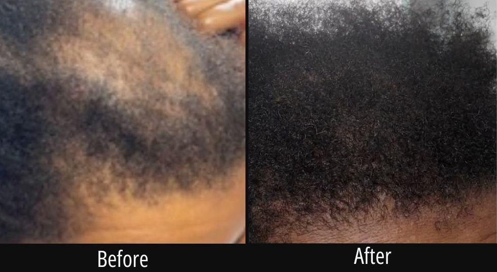 Before and after close-up of scalp showing darker, fuller hair growth compared to sparser initial appearance
