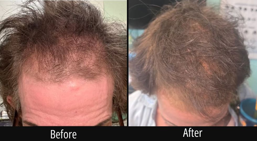 Before and after scalp treatment showing increased hair density and coverage on crown area