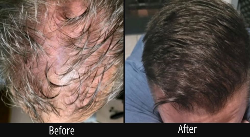 Before and after scalp treatment showing thicker hair growth on back of head