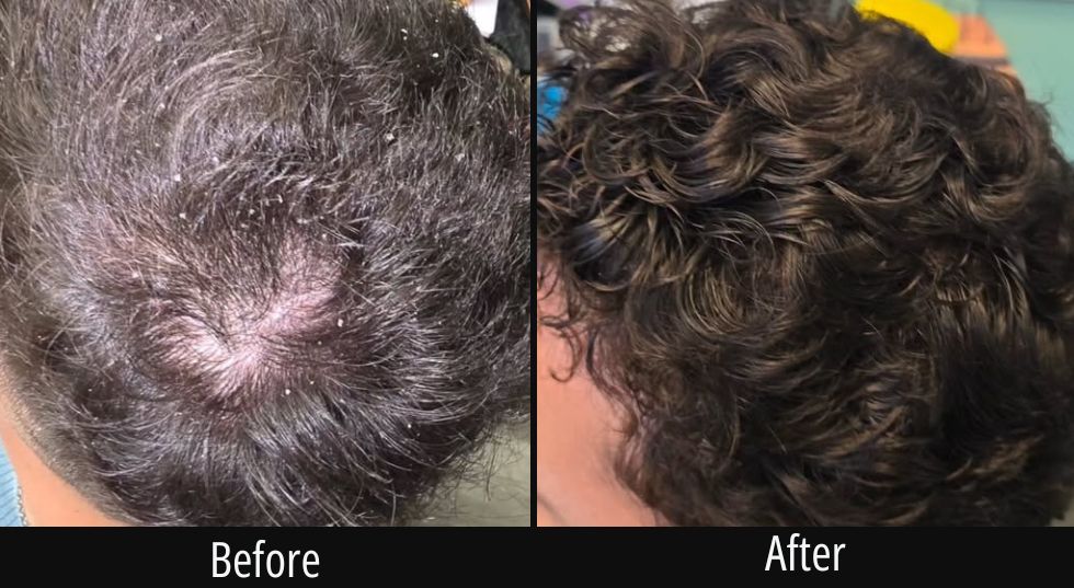 Before and after scalp treatment showing restored hair volume and texture on crown